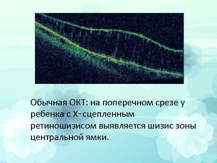 Обычная ОКТ: на поперечном срезе у ребенка с Х‑сцепленным ретиношизисом выявляется шизис зоны центральной