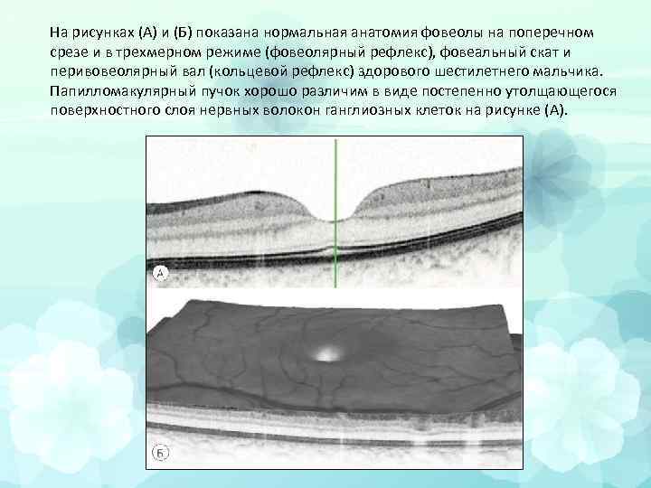На рисунках (A) и (Б) показана нормальная анатомия фовеолы на поперечном срезе и в
