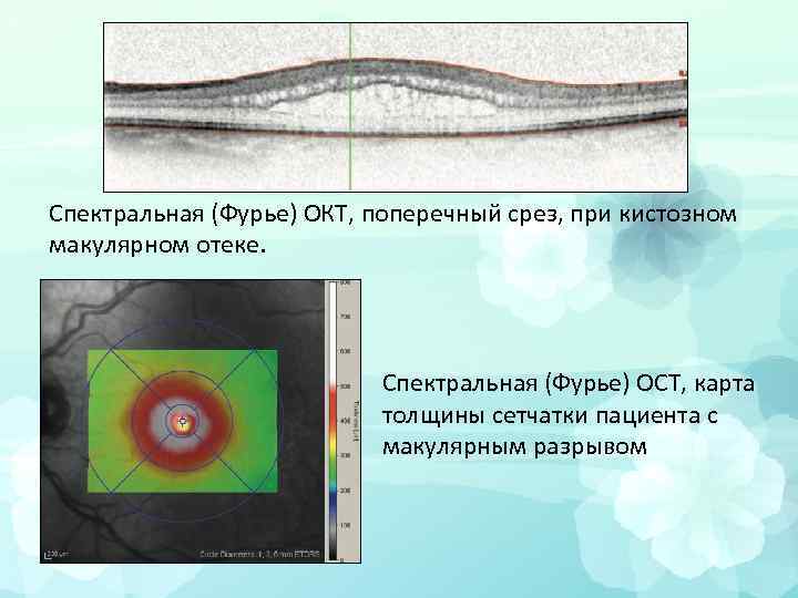 Спектральная (Фурье) ОКТ, поперечный срез, при кистозном макулярном отеке. Спектральная (Фурье) ОСТ, карта толщины