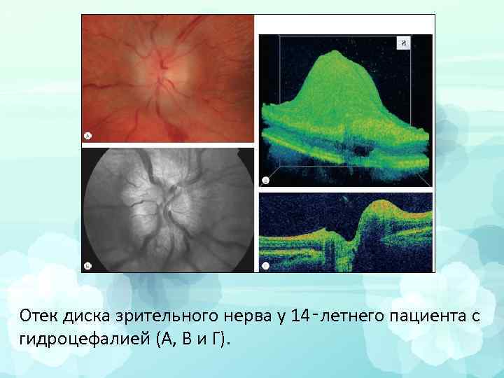 Отек диска зрительного нерва у 14‑летнего пациента с гидроцефалией (A, В и Г). 