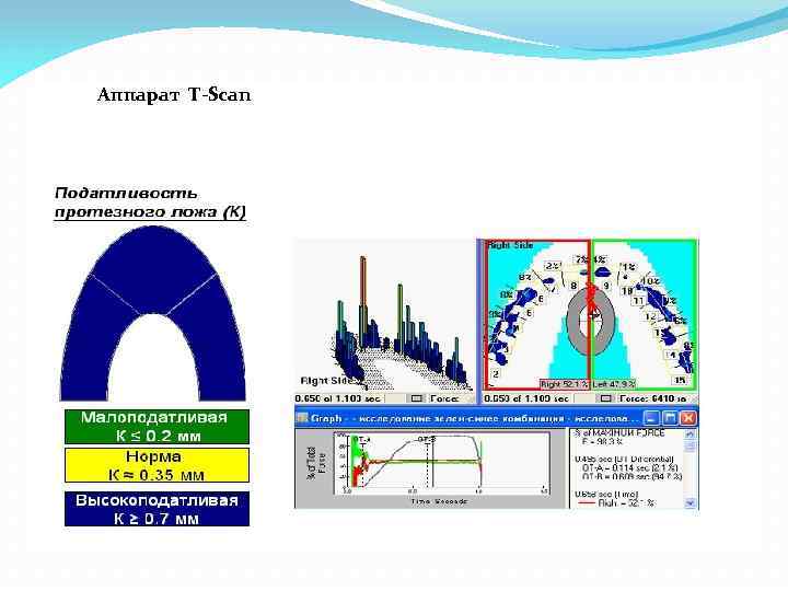 Аппарат T-Scan 