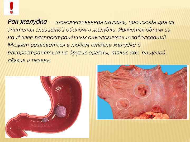 Рак желудка — злокачественная опухоль, происходящая из эпителия слизистой оболочки желудка. Является одним из