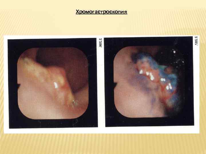 Хромогастроскопия 
