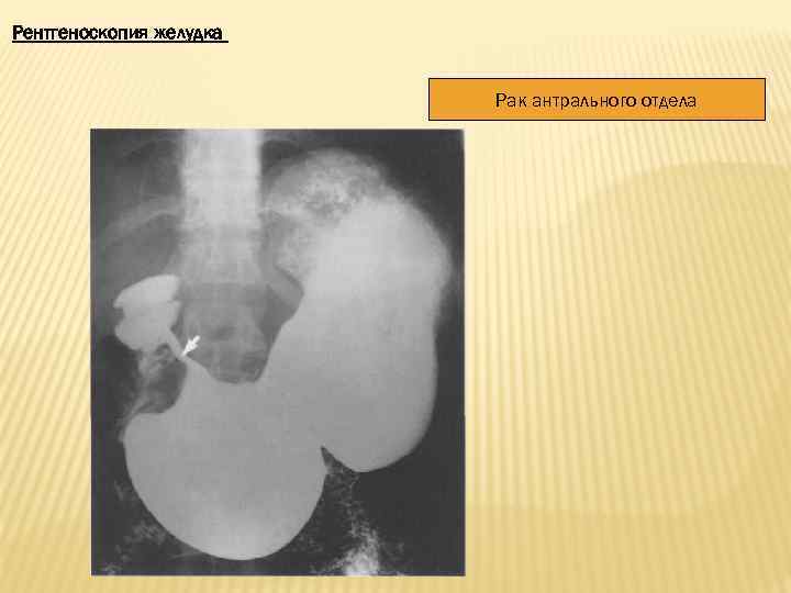 Рентгеноскопия желудка Рак антрального отдела 