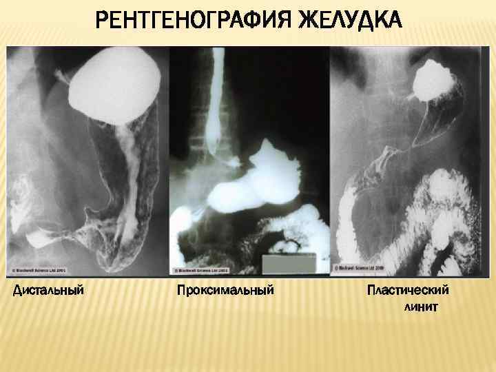 РЕНТГЕНОГРАФИЯ ЖЕЛУДКА Дистальный Проксимальный Пластический линит 