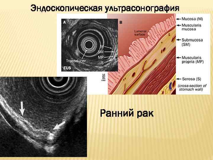 Эндоскопическая ультрасонография Ранний рак 