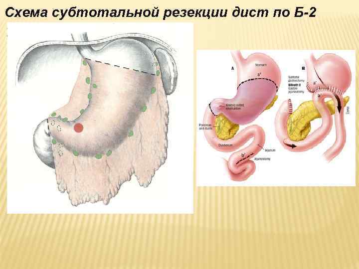 Схема субтотальной резекции дист по Б-2 