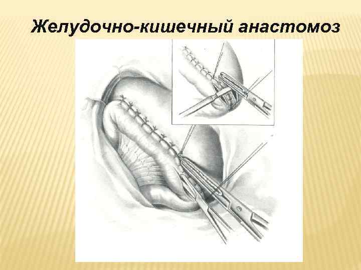 Желудочно-кишечный анастомоз 