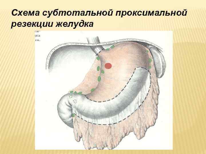 Схема субтотальной проксимальной резекции желудка 