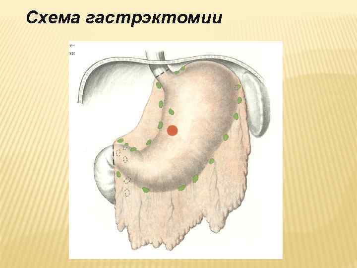 Схема гастрэктомии 