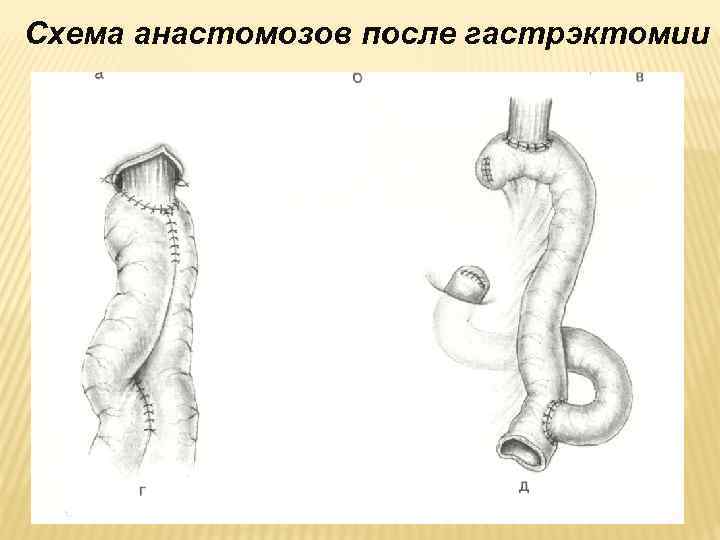 Схема анастомозов после гастрэктомии 