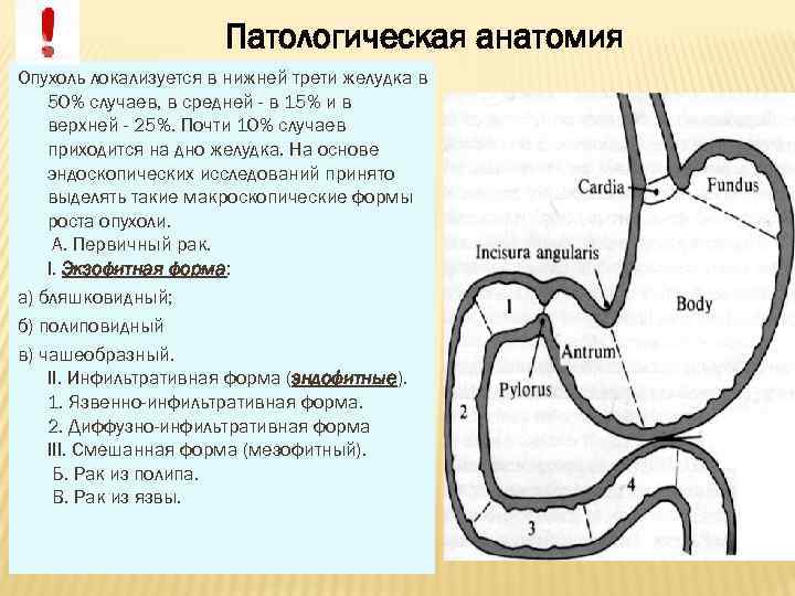 Патологическая анатомия Опухоль локализуется в нижней трети желудка в 50% случаев, в средней -