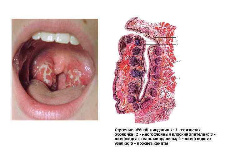 Строение нёбной миндалины: 1 - слизистая оболочка; 2 - многослойный плоский эпителий; 3 лимфоидная