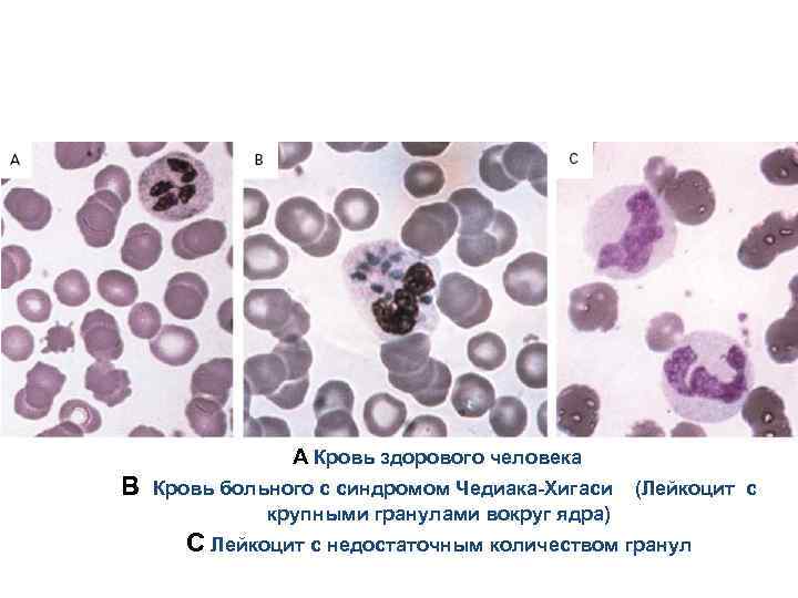 A Кровь здорового человека B Кровь больного с синдромом Чедиака-Хигаси крупными гранулами вокруг ядра)