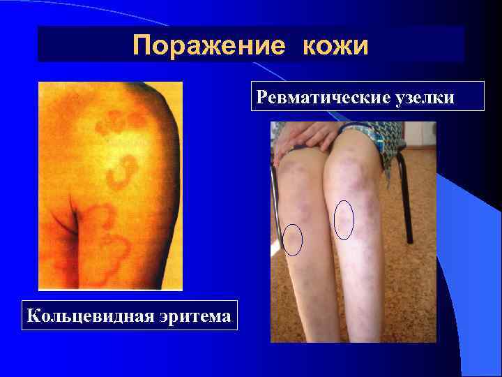 Поражение кожи Ревматические узелки Кольцевидная эритема 