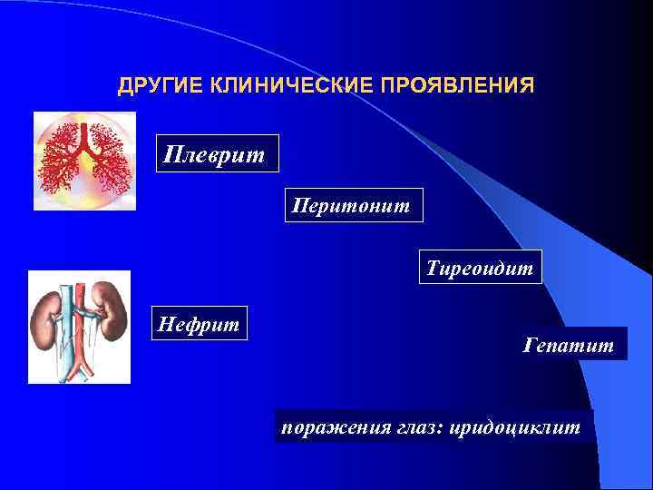 ДРУГИЕ КЛИНИЧЕСКИЕ ПРОЯВЛЕНИЯ Плеврит Перитонит Тиреоидит Нефрит Гепатит поражения глаз: иридоциклит 