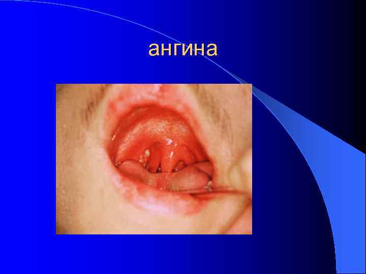 ангина 