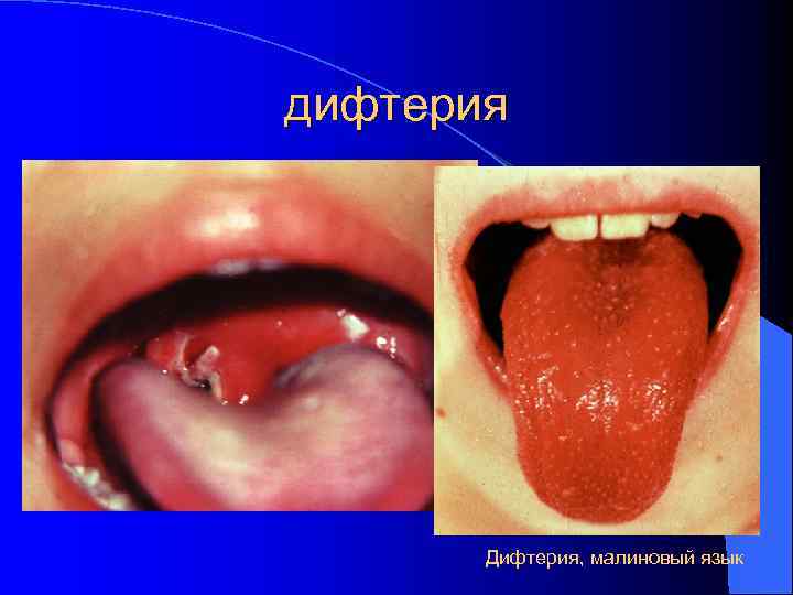 дифтерия Дифтерия, малиновый язык 