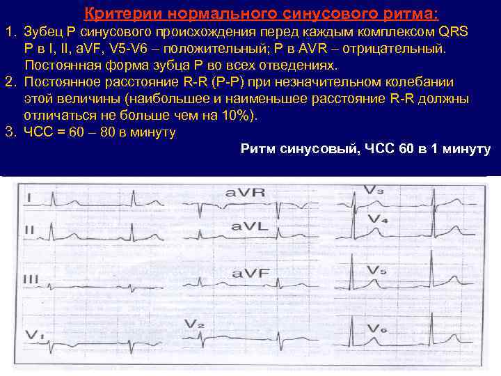 Критерии нормального синусового ритма: 1. Зубец Р синусового происхождения перед каждым комплексом QRS Р