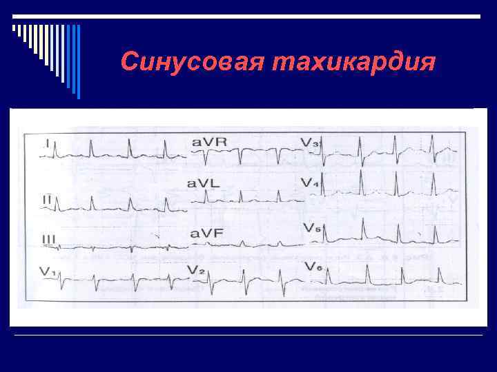 Cинусовая тахикардия 