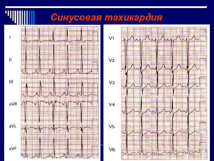 Синусовая тахикардия 