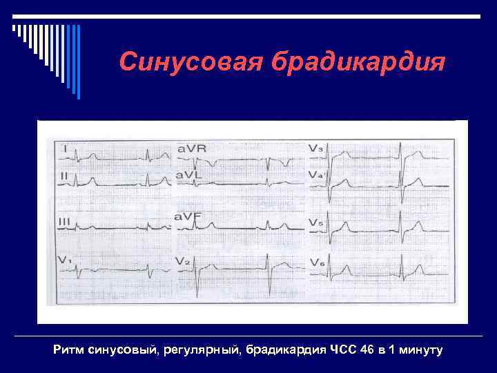 Синусовая брадикардия Ритм синусовый, регулярный, брадикардия ЧСС 46 в 1 минуту 