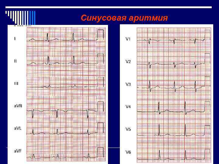 Синусовая аритмия 