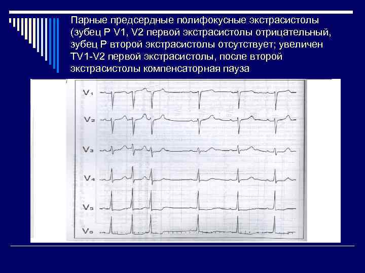 Парные предсердные полифокусные экстрасистолы (зубец Р V 1, V 2 первой экстрасистолы отрицательный, зубец