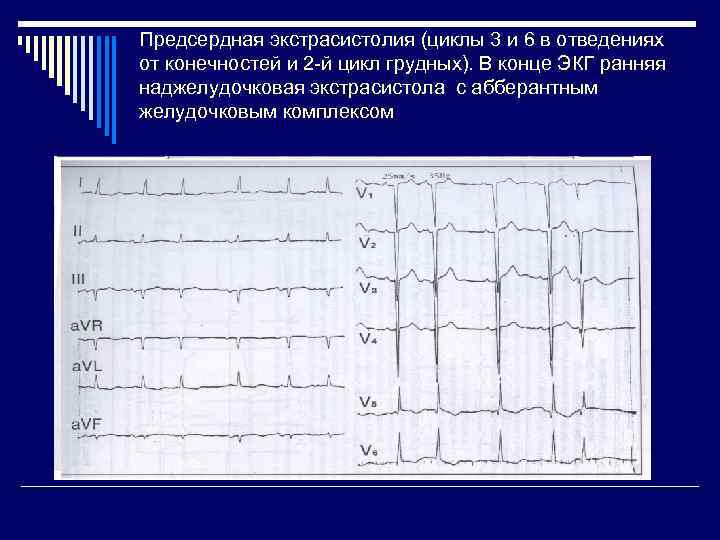 Предсердная экстрасистолия (циклы 3 и 6 в отведениях от конечностей и 2 -й цикл