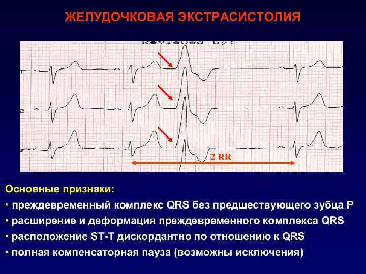 Желудочковая экстрасистолия ЭКГ-признаки: o отсутствие связи с зубцом Р. o уширение и деформация комплекса