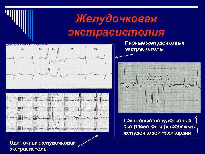 Желудочковая экстрасистолия Парные желудочковые экстрасистолы Групповые желудочковые экстрасистолы ( «пробежки» желудочковой тахикардии Одиночная желудочковая