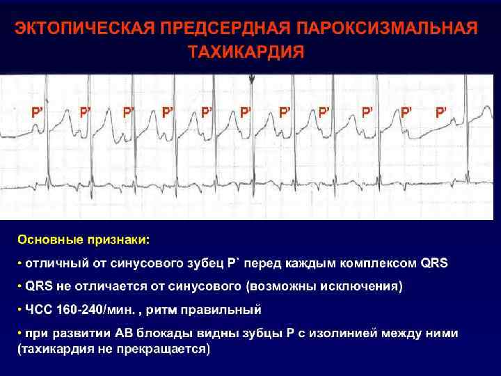 Пароксизмальная суправентрикулярная тахикардия o внезапно начинающийся приступ сердцебиения, импульсы для которого исходят из наджелудочковых