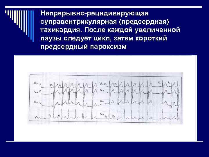 Непрерывно-рецидивирующая суправентрикулярная (предсердная) тахикардия. После каждой увеличенной паузы следует цикл, затем короткий предсердный пароксизм