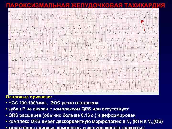 Пароксизмальная желудочковая тахикардия внезапно начинающийся приступ сердцебиения, импульсы для которого исходят из желудочков. Продолжительность