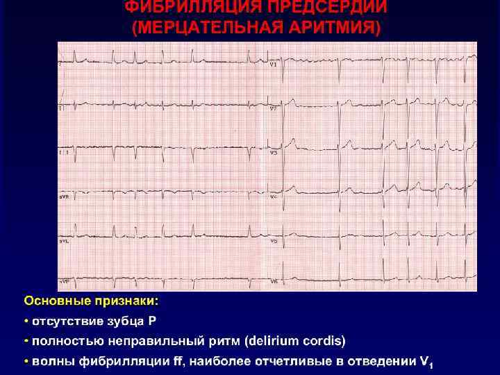 ФИБРИЛЛЯЦИЯ ПРЕДСЕРДИЙ МЕХАНИЗМЫ РАЗВИТИЯ ФП o Повышение автоматизма в одном или нескольких фокусах быстрой