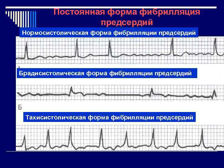 Постоянная форма фибрилляция предсердий Нормосистолическая форма фибрилляции предсердий Брадисистолическая форма фибрилляции предсердий Тахисистолическая форма