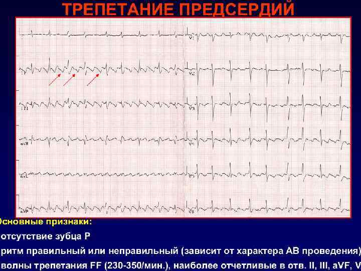 ГЕМОДИНАМИЧЕСКИЕ ПОСЛЕДСТВИЯ ФП 3 фактора могут влиять на гемодинамику при ФП: o Отсутствие систолы