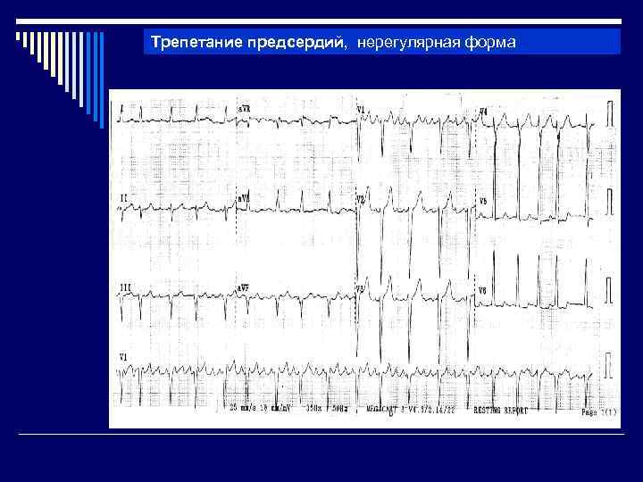 Трепетание предсердий, нерегулярная форма 
