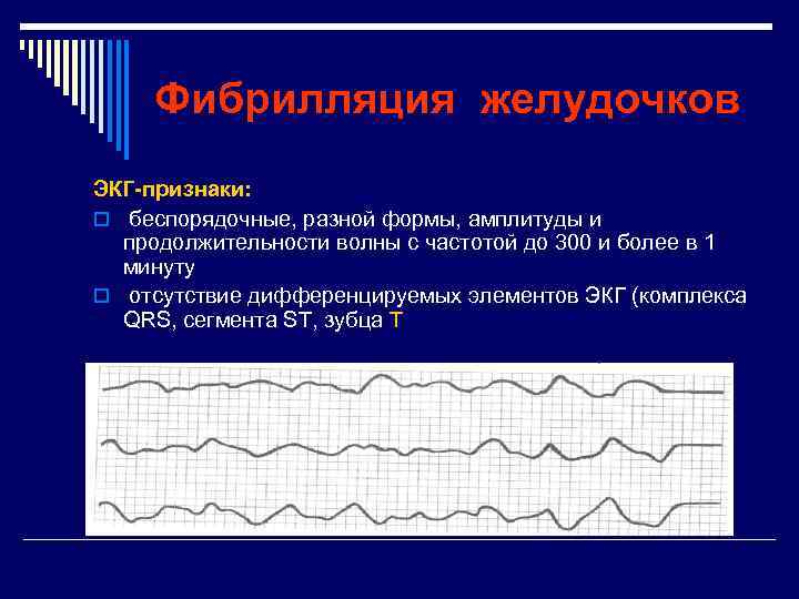 Фибрилляция желудочков ЭКГ-признаки: o беспорядочные, разной формы, амплитуды и продолжительности волны с частотой до