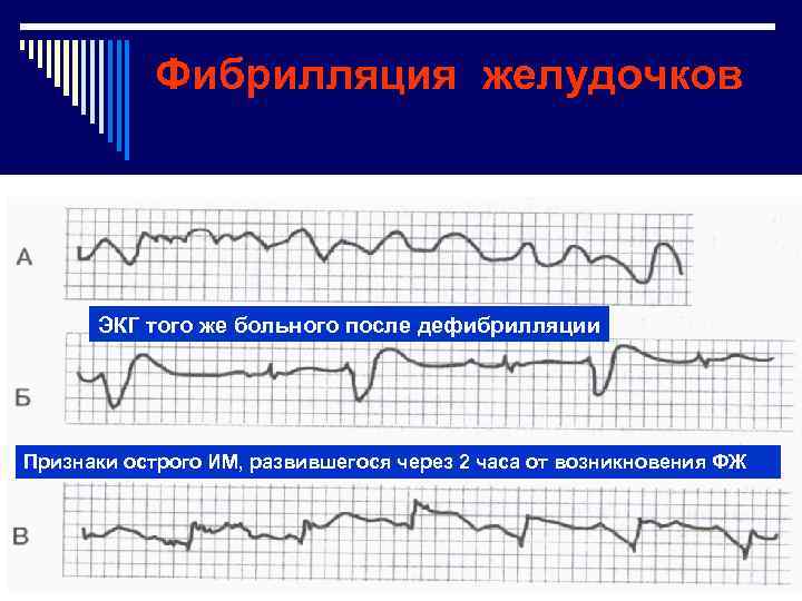 Фибрилляция желудочков ЭКГ того же больного после дефибрилляции Признаки острого ИМ, развившегося через 2