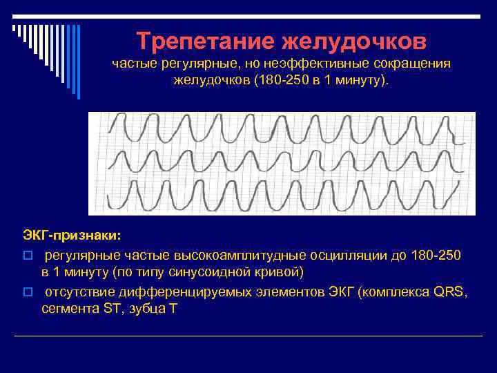 Трепетание желудочков частые регулярные, но неэффективные сокращения желудочков (180 -250 в 1 минуту). ЭКГ-признаки: