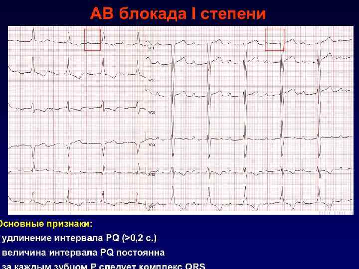 Атриовентрикулярная блокада замедление или полное прекращение проведения возбудительного импульса от предсердий к желудочкам АВ-блокада