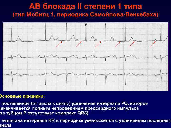 АВ-блокада II степени (неполная АВ-блокада) часть предсердных (синусовых) импульсов не проводятся на желудочки 