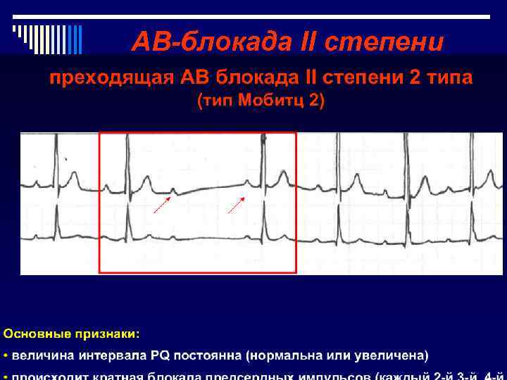 АВ-блокада II степени Неполная АВ-блокада I типа (по Мобитц), с периодикой Самойлова. Венкебаха –