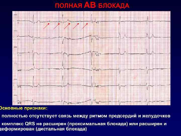 АВ-блокада II степени Неполная АВ-блокада II типа ( Мобитц II) ЭКГ-признаки o интервал PQ