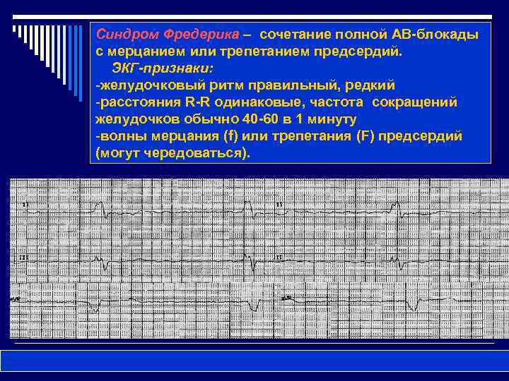 Синдром фредерика на экг фото