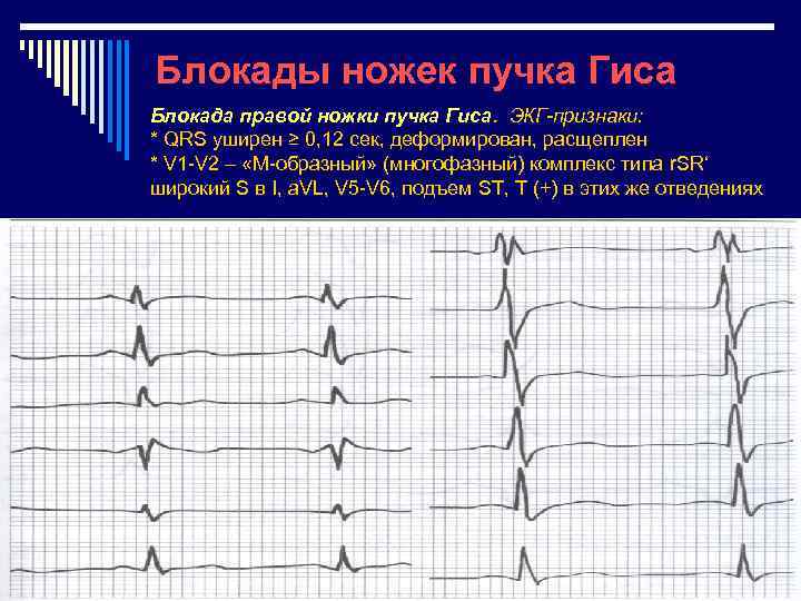 Блокады ножек пучка Гиса Блокада правой ножки пучка Гиса. ЭКГ-признаки: * QRS уширен ≥