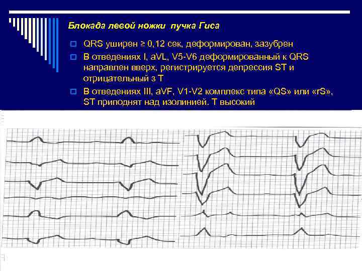 Блокада левой ножки пучка Гиса o QRS уширен ≥ 0, 12 сек, деформирован, зазубрен