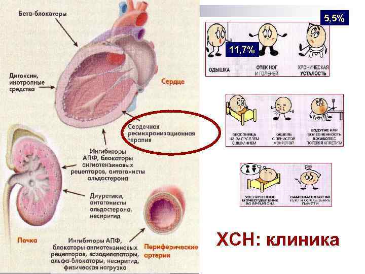 5, 5% 11, 7% ХСН: клиника 