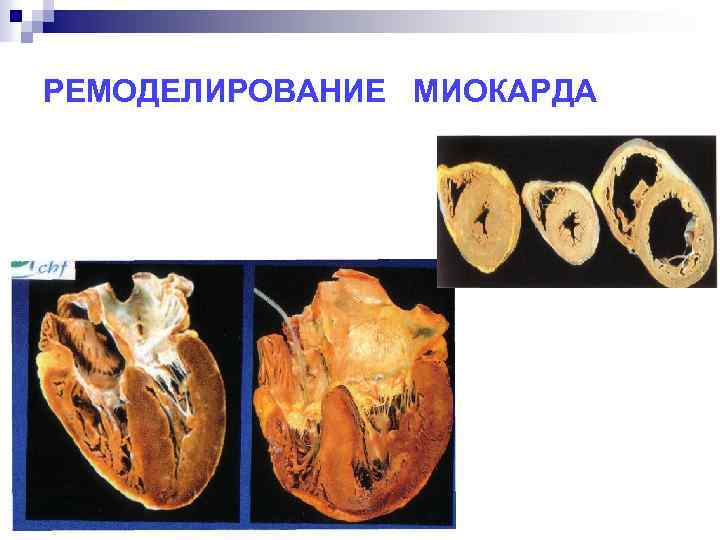 РЕМОДЕЛИРОВАНИЕ МИОКАРДА 